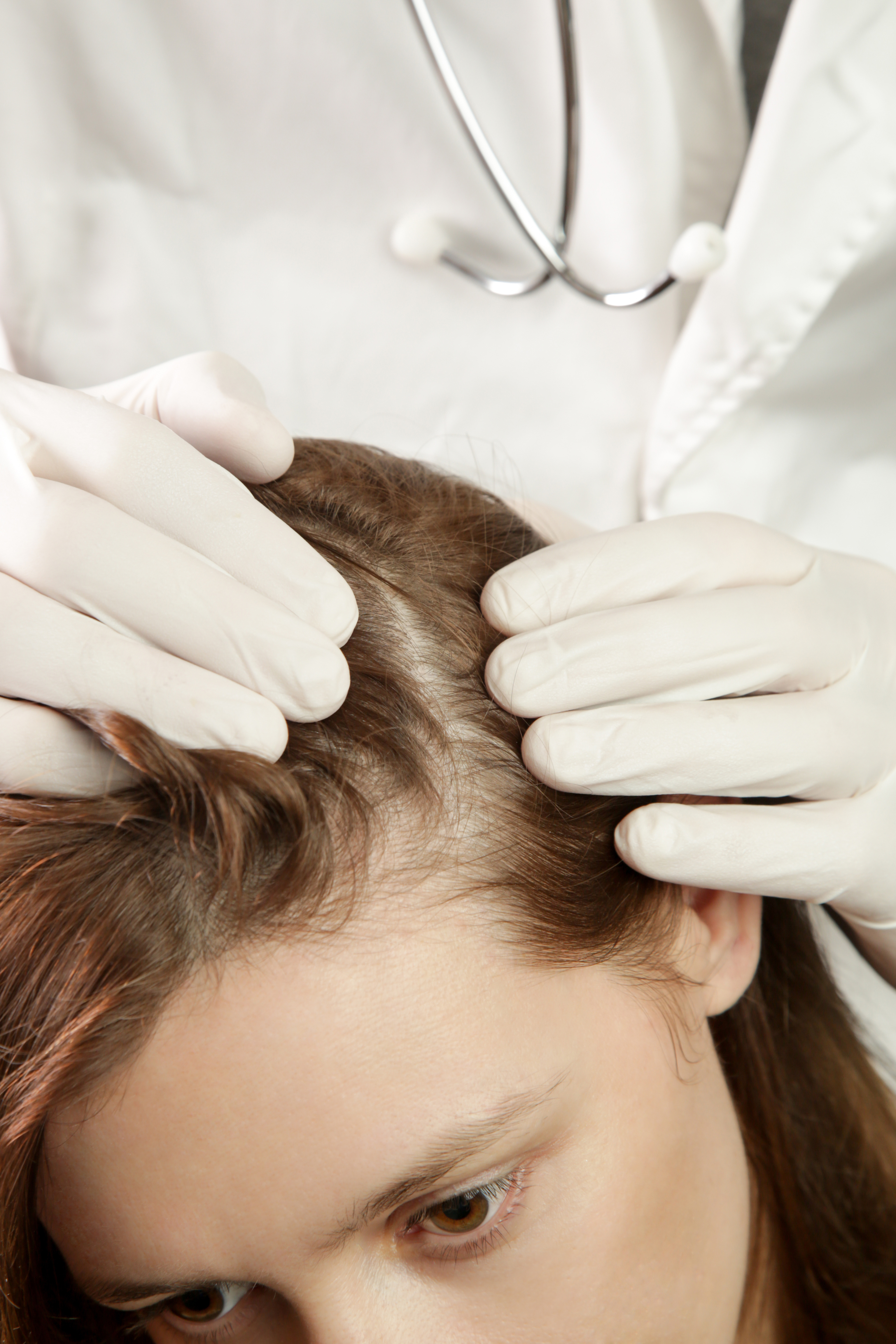 Doctor examining womans hair scalp, scalp eczema, dermatitis, psoriasis, hair loss, dandruff or dry scalp problem